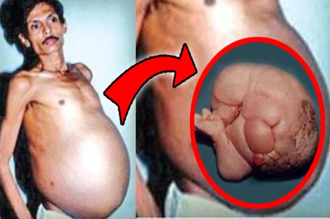 संजू भगत के पेट में निकले जुड़वां बच्चे